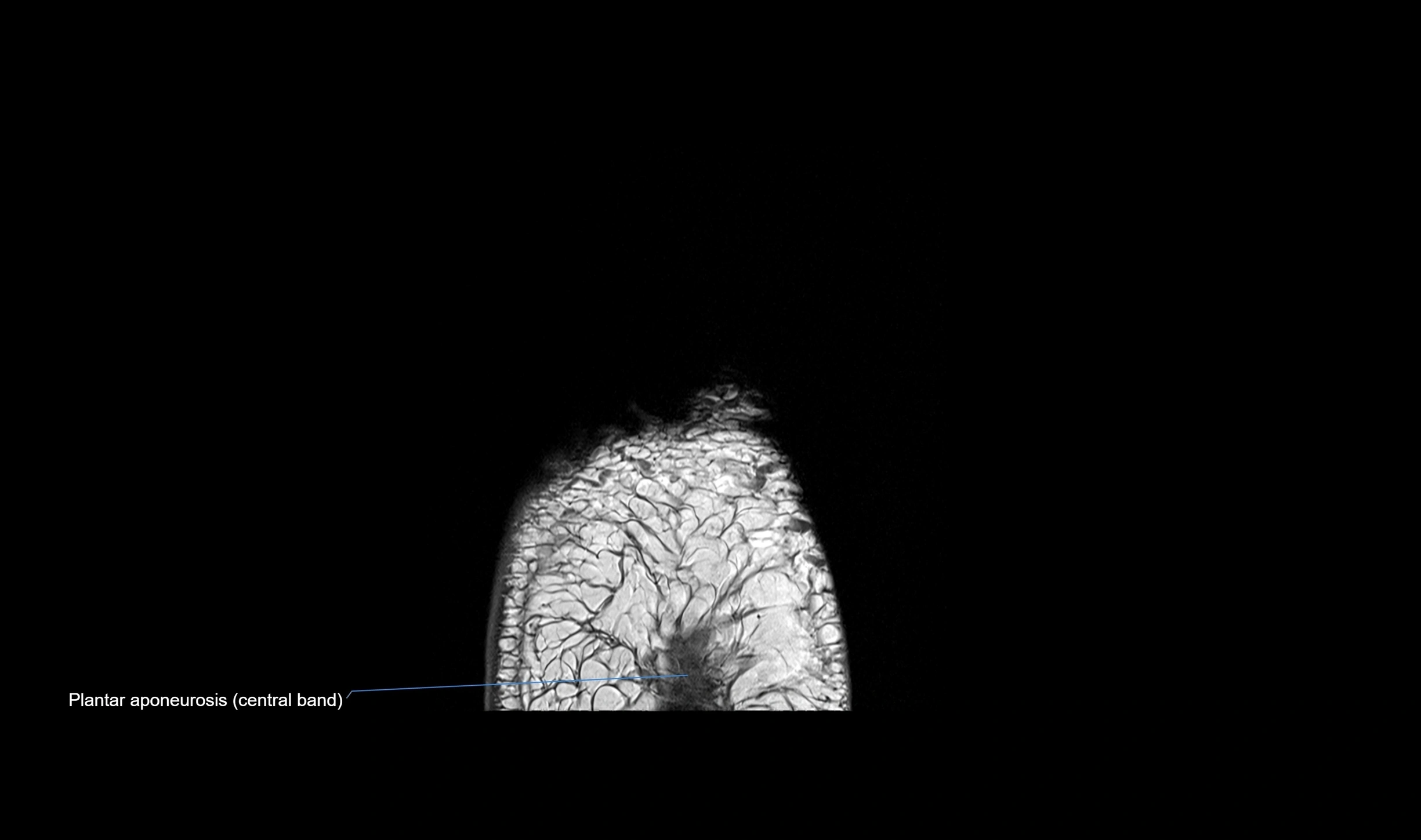 MRI mid foot coronal ligaments cross sectional anatomy 3T  radiology  image-img-00001-00042.webp